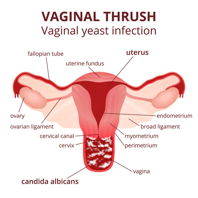 Yeast Infections Everything You Need To Know South Avenue Women S Services